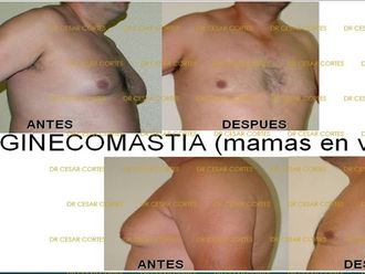 Reducción de mamas - 633395