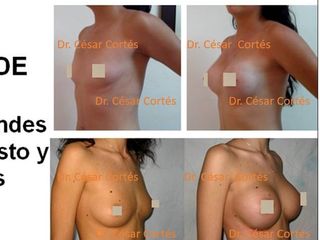 Antes y después de Implantes de mama