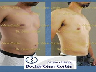 Clinicas De Liposuccion En Morelia Michoacan De Ocampo Multiestetica Mx