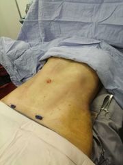 Marcaje abdominal, Dr. César Cortés Mendoza