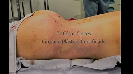 Aumento de glúteos, Dr. César Cortés Mendoza