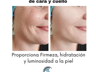 Rejuvenecimiento facial antes y después - 879406