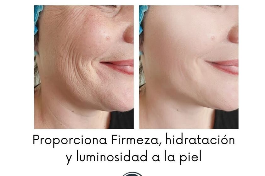 Rejuvenecimiento facial antes y después - 879406