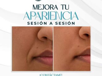 Rejuvenecimiento facial antes y después - 879409