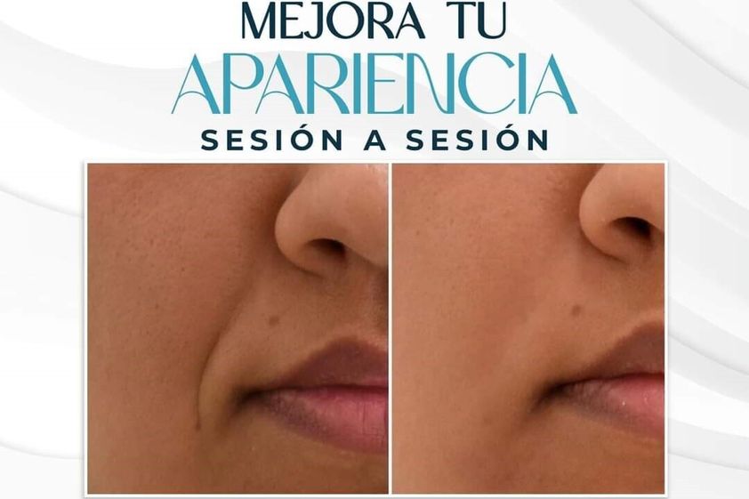 Rejuvenecimiento facial antes y después - 879409