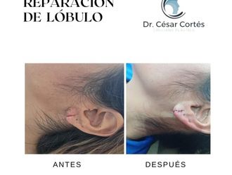 Otoplastia antes y después - 879410