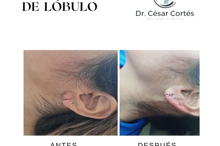 Otoplastia antes y después - 879410