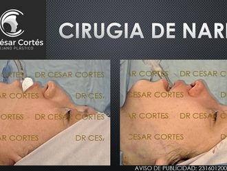 Rinoplastia antes y después - 879411