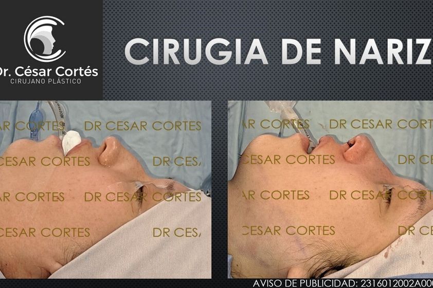 Rinoplastia antes y después - 879411
