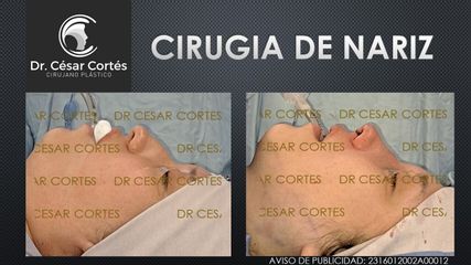 Dr. César Cortés Mendoza - Rinoplastia