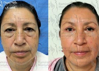 Antes y después de una  Cirugía de Párpados - Blefaroplastía