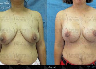 Antes y después de una Mastopexia con implantes