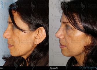 Antes y después de una rinoplastía o cirugía de nariz