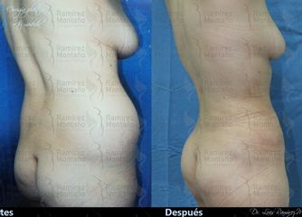 Antes y después de Liposucción