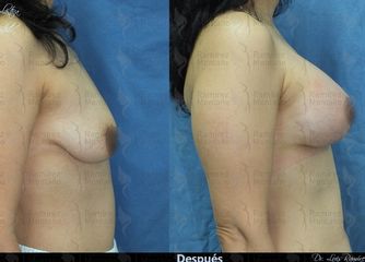 Antes y después de Mastopexia con implantes