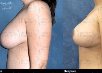 Antes y depués de Mastopexia simple