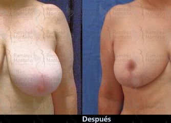 Antes y después de una Reducción Mamaria