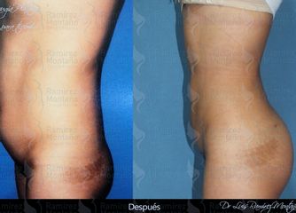Antes y después de Lipoescultura / Gluteo Brasileño