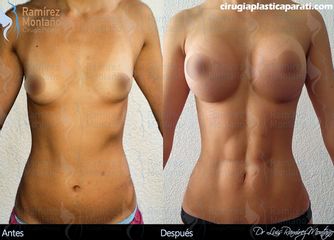 Antes y después de una Liposucción alta definición o HD