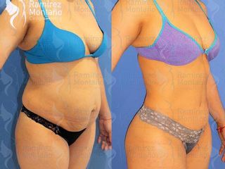 Antes y después de una  Abdominoplastía