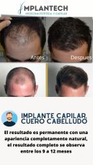 Trasplante de cabello - Dr. Jorge Delgado