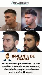Implante capilar en barba - Dr. Jorge Delgado