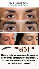 implante capilar en cejas - Dr. Jorge Delgado