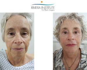 Antes y después de Rejuvenecimiento facial 