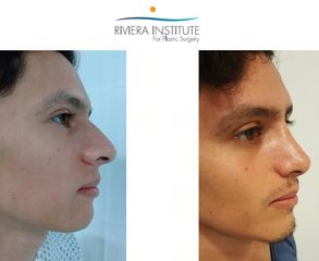 Antes y después de Rinoplastia