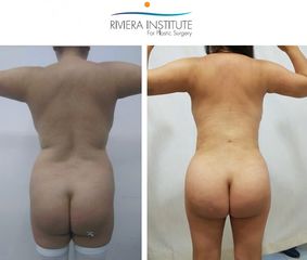 Antes y después de Liposucción 