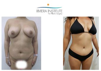 Antes y después de Abdominoplastia