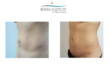 Antes y después de Abdominoplastia