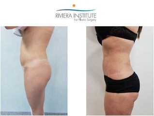 Antes y después de Abdominoplastia