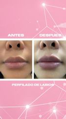 Antes y después de Aumento de labios