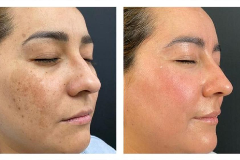 Peeling antes y después - 827215