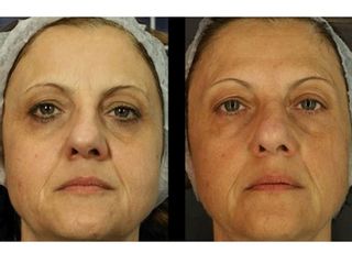 Antes y después de Tratamientos faciales