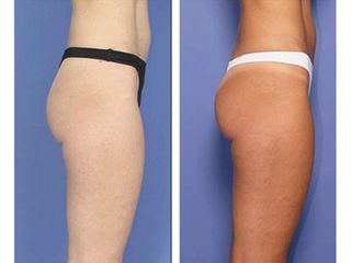Antes y después de Tratamientos reafirmantes