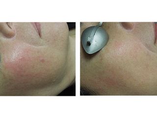 Antes y después de Manchas en la piel