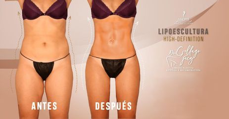 Lipoescultura HD - Dra. Jacy Collazo Daza