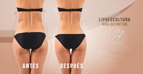 Lipoescultura HD - Dra. Jacy Collazo Daza