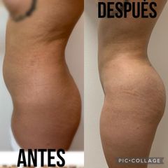 Lipoescultura - Dra. Jacy Collazo Daza
