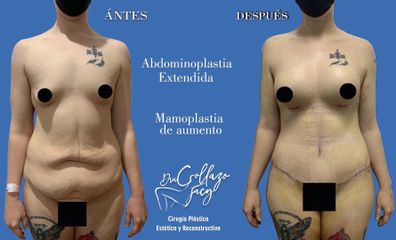 Abdominoplastia + Aumento de busto - Dra. Jacy Collazo Daza