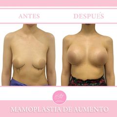 Aumento de busto - Dra. Jacy Collazo Daza