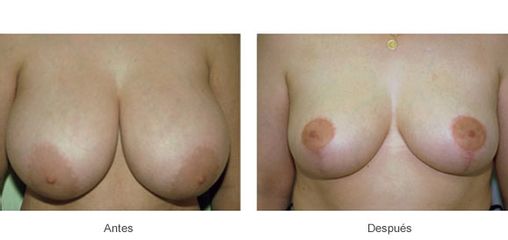 Antes y después de Mastopexia