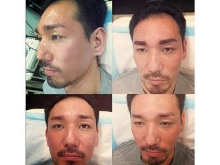 Antes y después de Micropigmentación