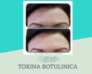 Antes y después de Toxina Botulínica
