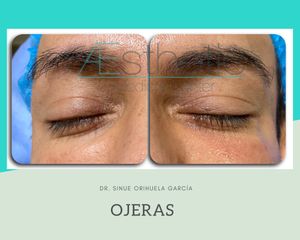 Tratamiento de Ojeras - Dr. Sinué Orihuela García