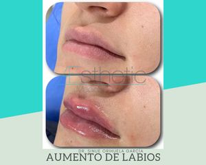 Aumento de labios - Dr. Sinué Orihuela García