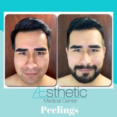 Peeling - Dr. Sinué Orihuela García