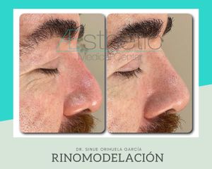 Antes y después de Rinomodelación con ácido hialuronico 